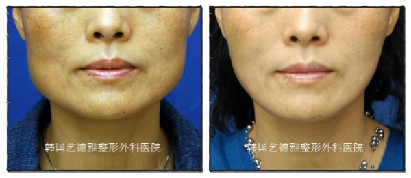 由陈熏院长进行的腮骨缩小术，术前术后对比图